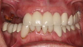 Dental implants and PFM bridge 467144