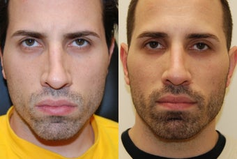 Non-Surgical Rhinoplasty with Silikon-1000 before 261247
