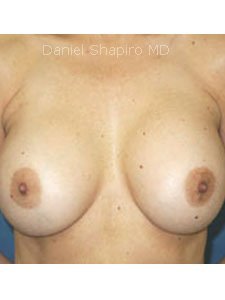 Corrective Breast Imlant Surgery after 250008