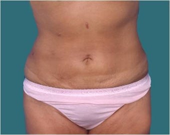 Liposuction after 590650
