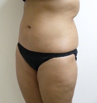 Liposuction of waist, abdomen and back before 124840