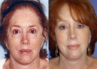 Skin Resurfacing before 366802