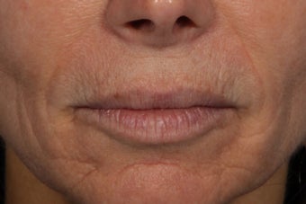 Radiesse to Lower Face after 309746