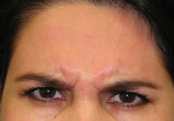 Botox before 371665