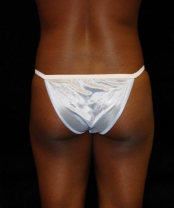 Buttocks Augmentation by Fat Grafting before 177911
