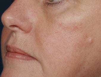 Yag laser after 140105
