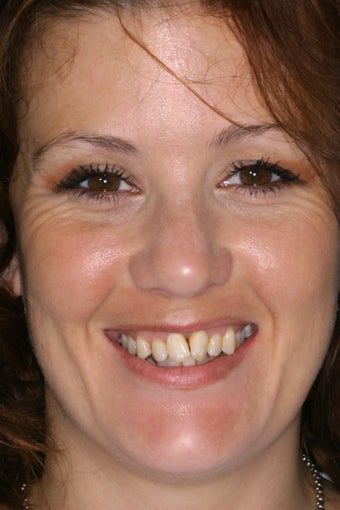 Smile Makeover With Porcelain Veneers before 414980
