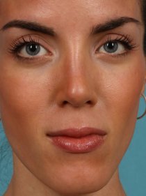 Revision Rhinoplasty after 581089