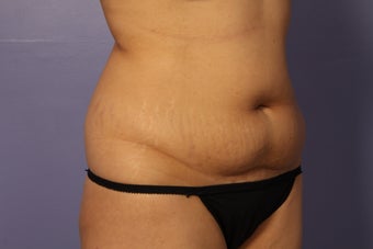 Liposuction before 588022