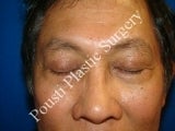 Eye Surgery (Blepharoplasty) after 617445