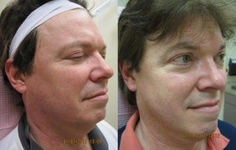 Intense pulsed light (IPL) photofacial for severe sun damage before 390175
