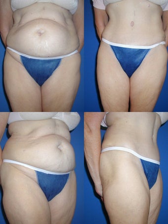Tummy Tuck before 328461