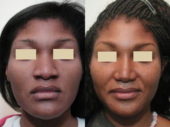African American Rhinoplasty before 137748
