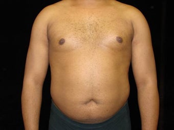 Liposuction of Abdomen, Waist, Flanks, Pecs with 6 Pack Abdominal Etching before 203529