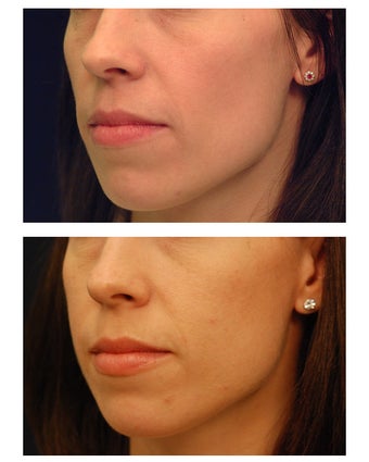 Cheek Augmentation after 347496