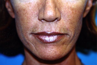 Upper and Lower Direct Lip Lift before 409920