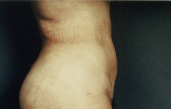 Liposuction after 217864