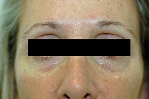 Restylane for dark circles under the eyes before 93362
