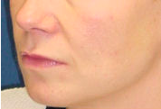 Lift Lip before 635458