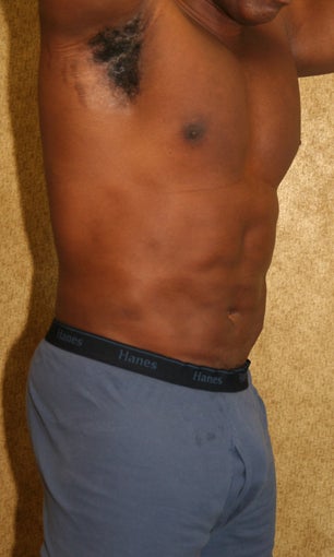 liposuction of abdomen and flanks of man from Los Angeles 583370