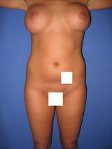 Liposuction Surgery before 123627