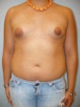 Tubular breast augmentation
