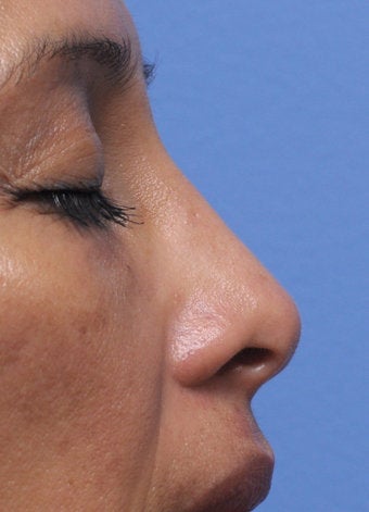 Non-Surgical Nose Job 430195