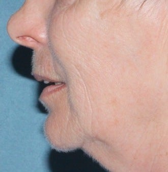 Laser resurfacing for mouth before 376158