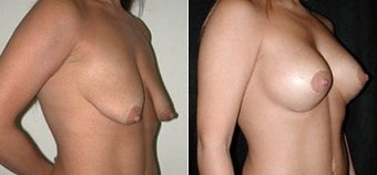 Breast Lift and Augmentation before 110086