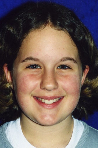Orthodontic braces to correct a Class II malocclusion 404703