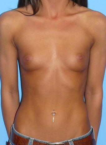 Breast Augmentation before 177441