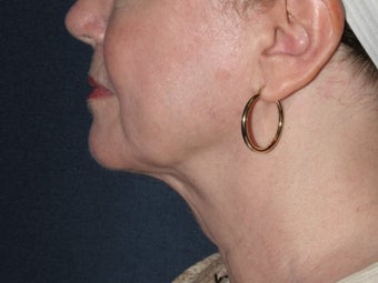 Liposculpture 486632