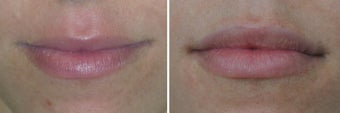 Lip Augmentation before 388079