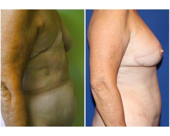 DIEP - Breast Reconstruction before 331100