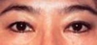Blepharoplasty before 209324