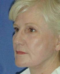 Facelift Surgery, Nasolabial Augmentation and Skin Resurfacing after 324043
