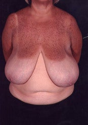 Minimal Scar Breast Reduction before 85815