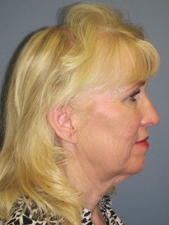 Neck Lift, Platysmaplasty 634754