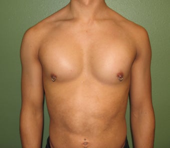 Pectoral Implants after 421489