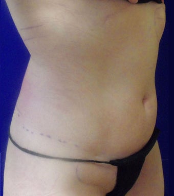 VASER Shape to Abdomen after 433049
