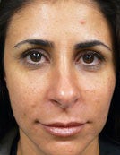 Hydrelle Injection For Treating Laugh Lines or Nasolabial Folds after 196049