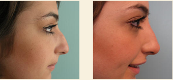 Non-Surgical Nose Job before 627869