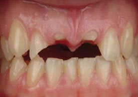 Dental Implants For Missing Front Teeth before 504315