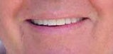 Zoom whitening before 109173
