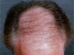 Hair Transplant before 426678