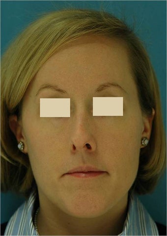 Rhinoplasty, Septoplasty before 124594
