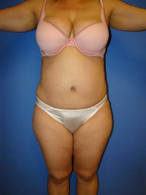 Tummy Tuck (Abdominoplasty) after 117394