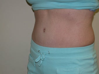 Tummy Tuck after 525166
