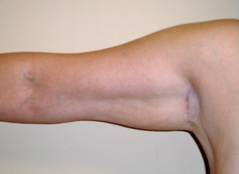 Brachioplasty (Arm Lift) after 171913