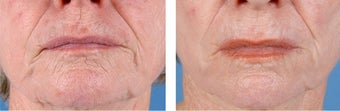 Active FX Fractional Laser Resurfacing after 253993